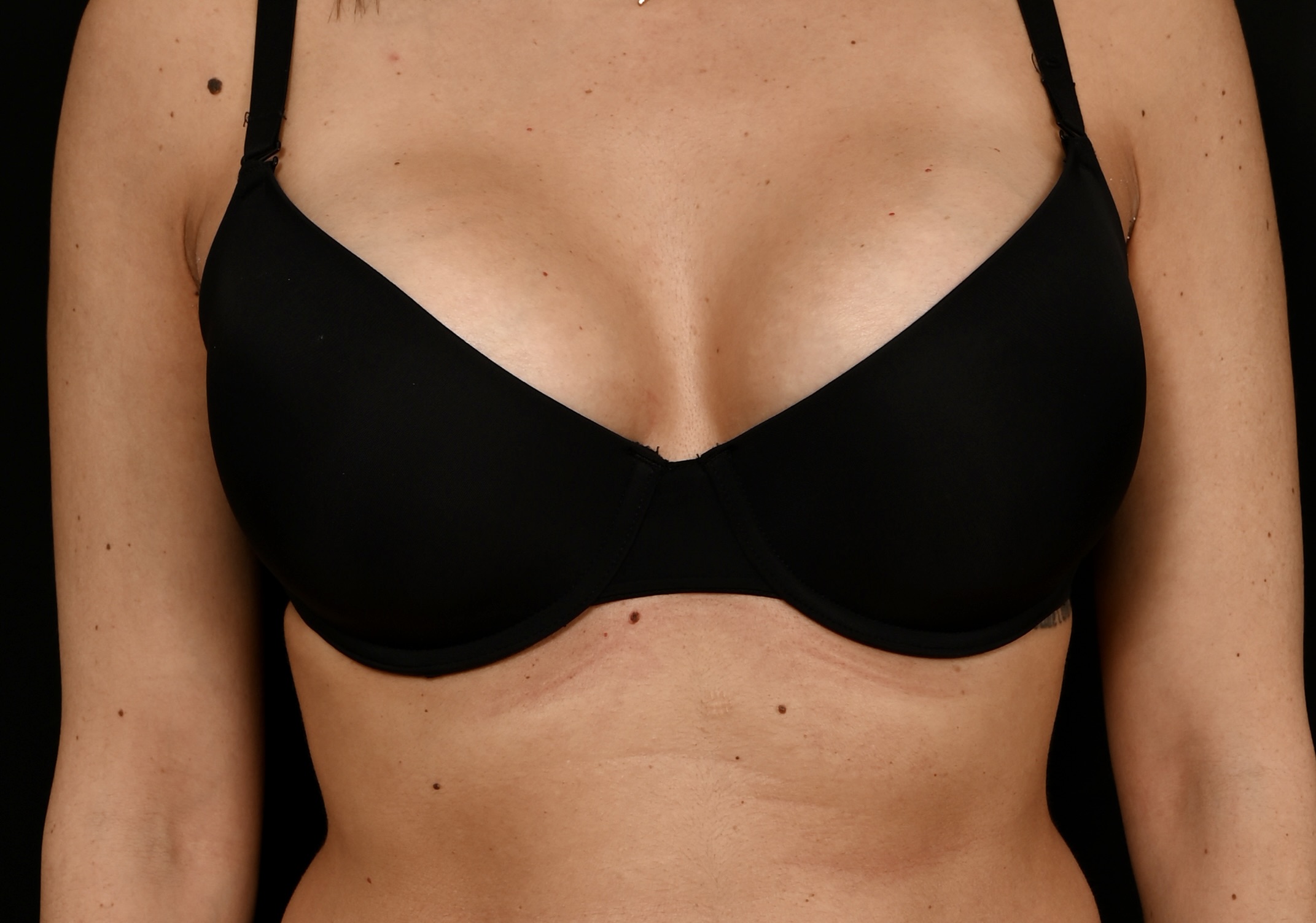 Augmentation mammaire par prothese : quelles cicatrices ? 