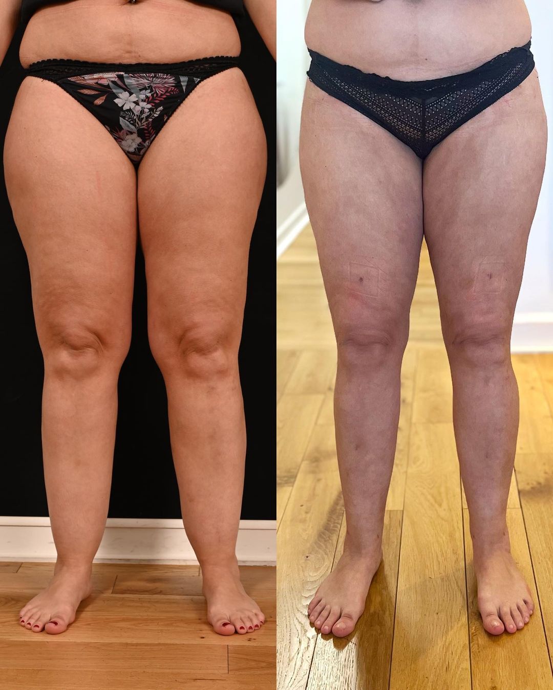 c'est quoi lipo Liposuccion 360 pour affiner votre taille - Laval Liposuccion Bordeaux - Clinique Esthétique