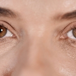 Blépharoplastie des paupières - Chirurgie esthétique des yeux avec rajeunissement du regard