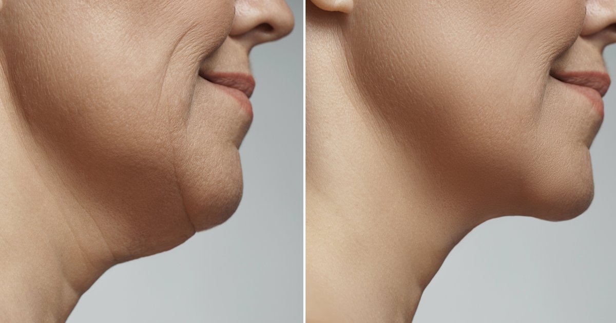 Comparaison âge vieillissement facial rajeunissement Bandol Comparaison âge vieillissement facial processus de vieillissement et rajeunissement par lifting