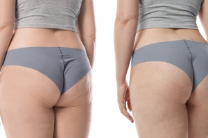 Chirurgien esthétique pour lifting des fesses près de Marseille Prado