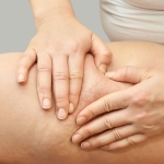 Femme examinant cellulite lipœdème symptômes cuisse douleur accumulation graisse