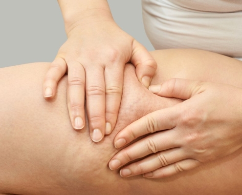 Femme examinant cellulite lipœdème symptômes cuisse douleur accumulation graisse