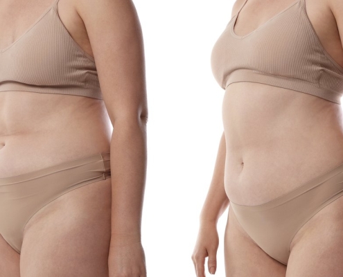 Résultats avant après liposuccion lipofilling combiné transformation silhouette complète