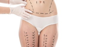 Meilleure clinique pour une abdominoplastie près de Marseille Prado