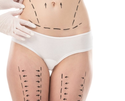 Marquage chirurgical liposuccion abdomen cuisses planning intervention suites opératoires