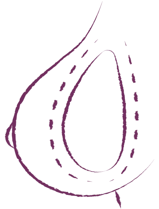 Augmentation mammaire mini invasive Preservé TM illustration 2