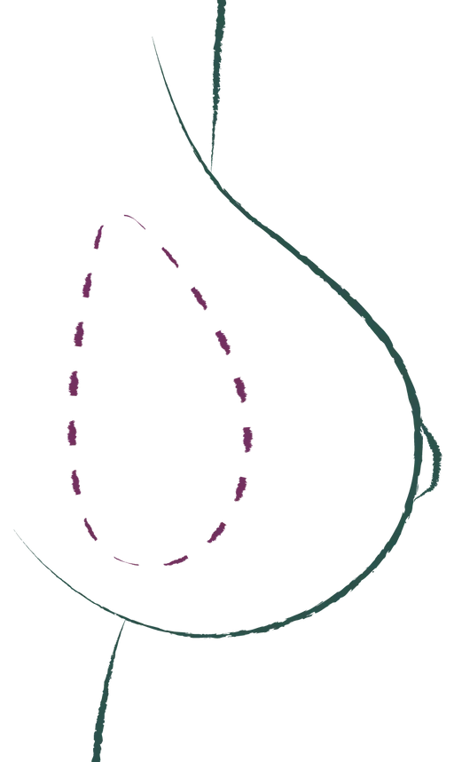 Augmentation mammaire mini invasive Preservé TM illustration 8